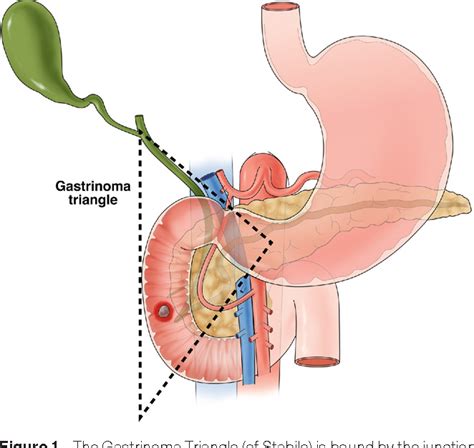 Figure 1 from Diagnosis of the Zollinger–Ellison syndrome. | Semantic ...