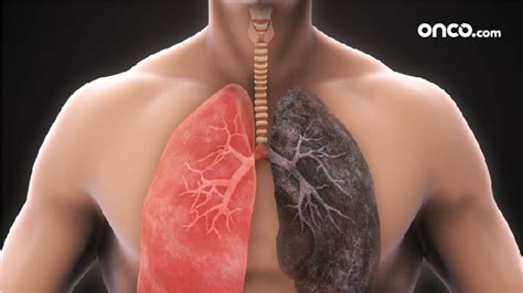 Lung Cancer Surgery | Onco.com