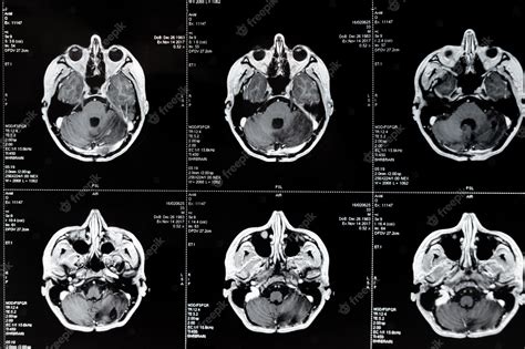 Resonancia magnética con tumor cerebral resonancia magnética | Foto Premium