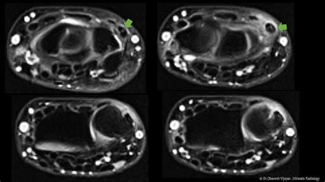 Ultimate Radiology : Extensor Carpi Ulnaris (ECU) tendinosis with interstitial tear