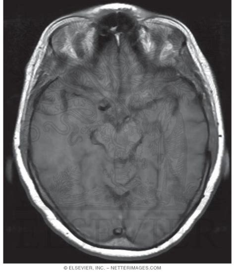 T1 Axial MRI Through the Optic Chiasm