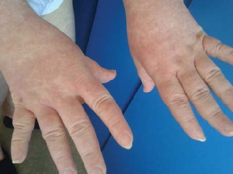 Maculopapular rash 2 weeks after the withdrawal of lamotrigine and... | Download Scientific Diagram