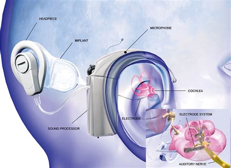 Cochlear and Brainstem Implantation - Neurosurgery Clinics