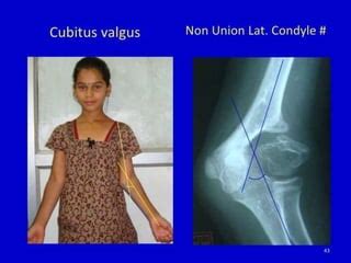 Cubitus valgus | PPT