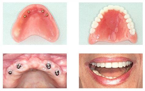 Denture Implants Sydney | Denture Care Clinic