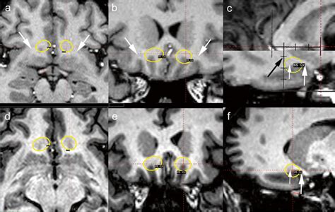 Gamma-knife targets on the pre-surgical T1 MRI axial (a), coronal (b),... | Download Scientific ...