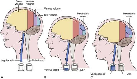 Intracranial pressure, high intracranial pressure causes, symptoms & treatment