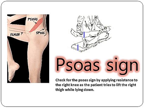 Psoas Sign