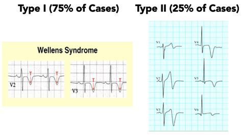 Types of Wellens' - REBEL EM - Emergency Medicine Blog