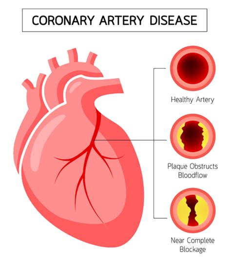 Center for Coronary Artery Disease | Patients | Minneapolis Heart Institute Foundation