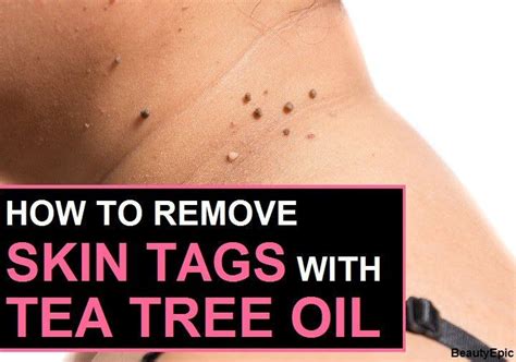 How To Remove Skin Tags With Tea Tree Oil? | Skin tag removal, Oils for ...