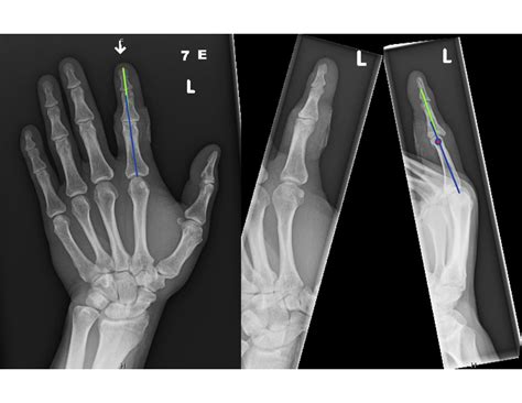 Proximal Interphalangeal Joint Dislocation – Handipedia