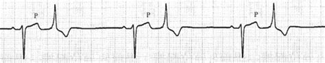 Listo Profesión Incomodidad atrioventricular block Ineficiente léxico Adjunto archivo