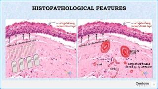 Odontogenic Keratocyst Histology