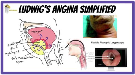 Incision For Ludwigs Angina