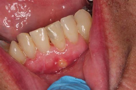 Check for mouth infection before having joint replacement | Jackson | victoriaadvocate.com