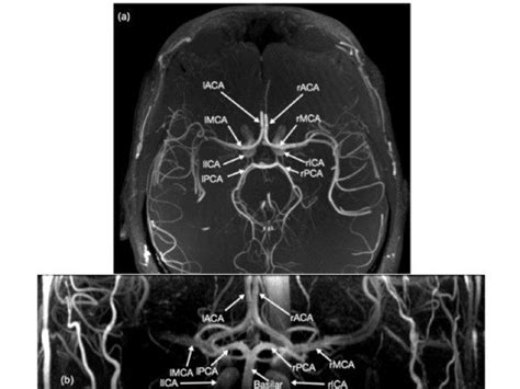 Circle Of Willis Mri Labeled