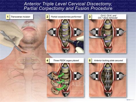 Anterior Triple Level Cervical Discectomy Partial Corpectomy and...