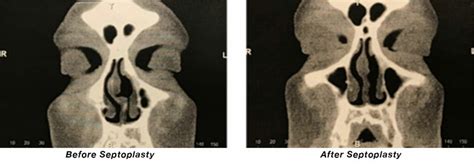 What is Deviated Septum Surgery? | Ask the ENT | Capital Otolaryngology