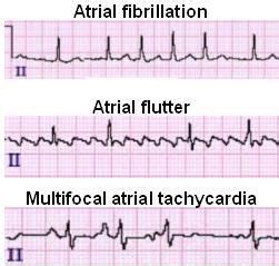 Coarse V Fib Ecg - theme-arabic