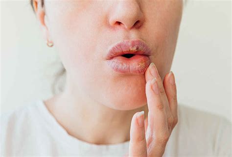 Lip Allergy: Cause, Symptoms, Treatment and Prevention of Lip Allergy