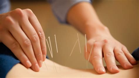 Clinics that offer Acupuncture Treatment - The Health Blog - Fidoc