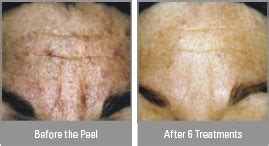 Vitalize Chemical Peel® Virginia Beach | Skin Care Treatment