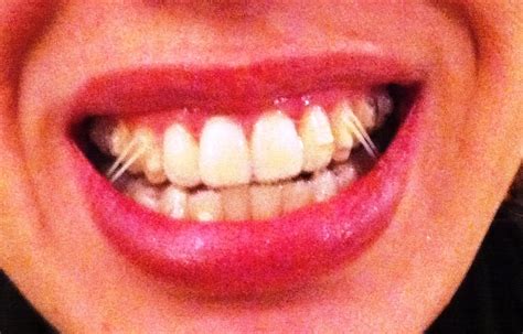 Welcome to my invisalign blog......: Not MORE rubber bands!!!!