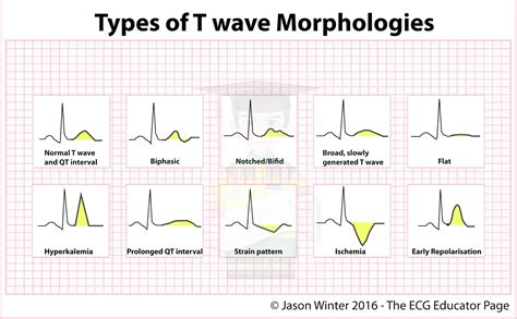 ECG Educator Blog : Types of T-waves