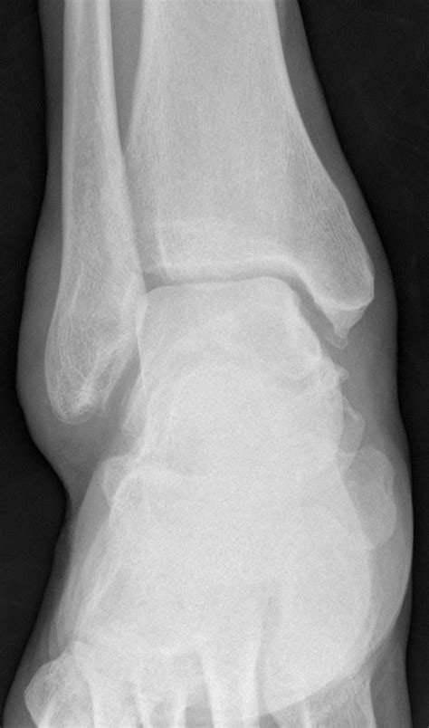 os subtibiale is a rare, genuine accessory ossicle and normal variant related to the posterior ...