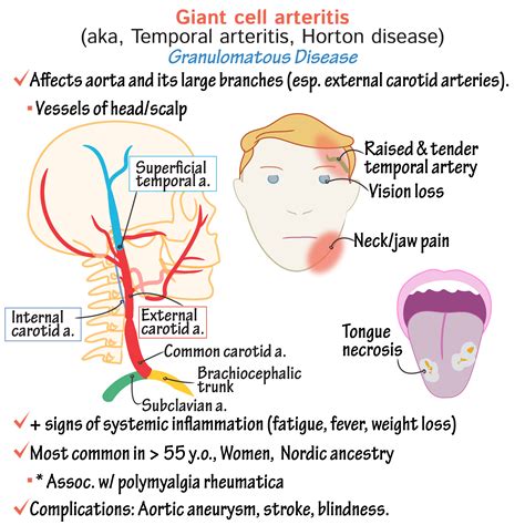 Clinical Pathology Glossary: Giant Cell Arteritis | ditki medical ...