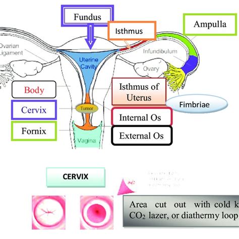 | Cone biopsy (conization of the cervix). | Download Scientific Diagram