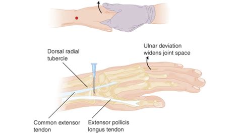 Arthrocentesis of the Wrist Joint - Internet Book Of MSK Ultrasound