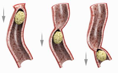 Bowel Perforation: Symptoms, Causes, and Treatments