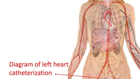 Right And Left Heart Catheterization