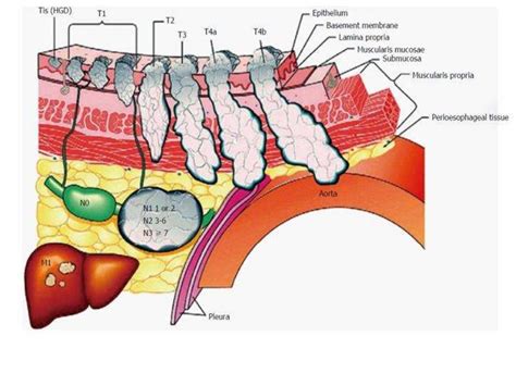 Gastroesophageal Junction Carcinoma