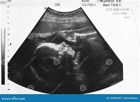 Ultrasound Photo of Unborn Baby in Mother`s Womb Stock Photo - Image of child, health: 142004760