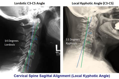 Can Cervical Myelopathy Cause Death