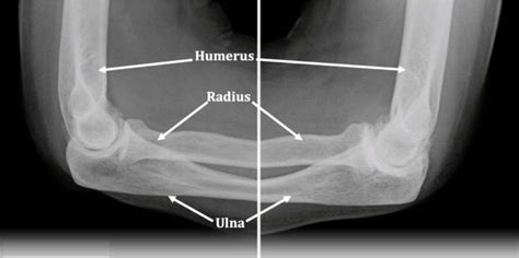 Frozen Elbow | Stiff Elbow | Colorado Elbow Specialist