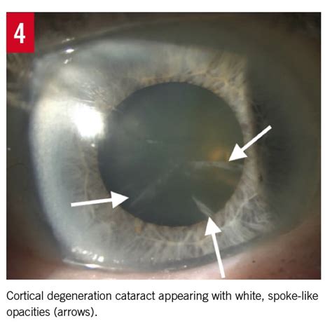 The Aging Crystalline Lens: A Review of Cataracts | Consultant360