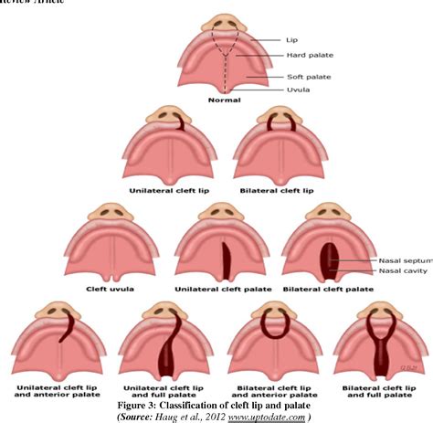 Figure 1 from EPIDEMIOLOGY-CLINICAL PROFILE OF CLEFT LIP AND PALATE ...