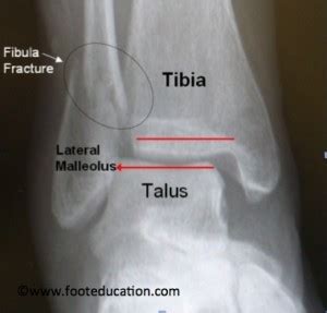 Ankle Fracture ORIF - FootEducation