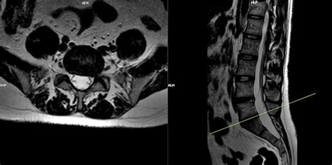 Left paracentral-foraminal protrusion at the L5-S1 disc levels on the... | Download Scientific ...