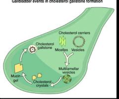 Pathophysiology Of Gallstone Formation
