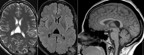 Radiology MRI: Cavum Velum Interpositum on MRI