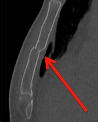 Sternum Fracture lateral chest xray CXR | ALiEM