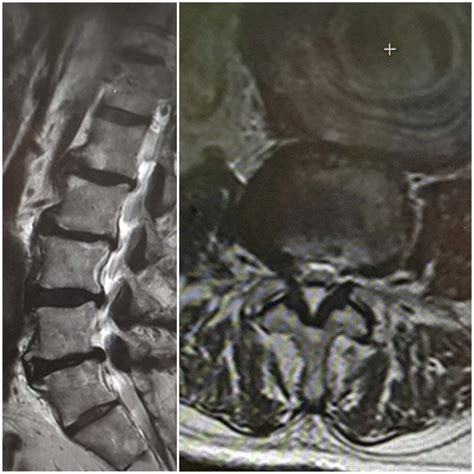 Lumbar Disc Disease Mri