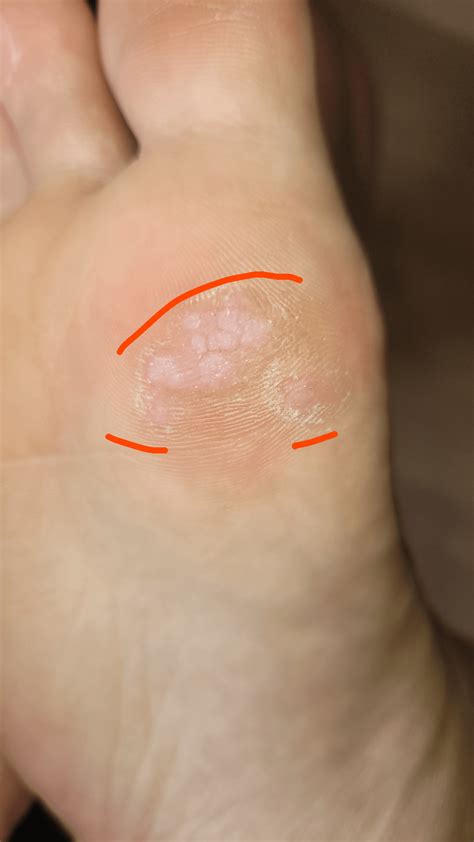 Plantar wart treatment : r/DermatologyQuestions