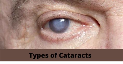 Different Types of Cataracts: Signs, Causes & Ways To Prevent!