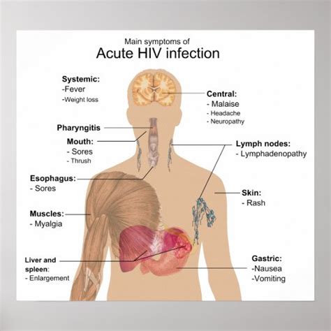 Póster Síntomas principales de la infección VIH aguda | Zazzle.es